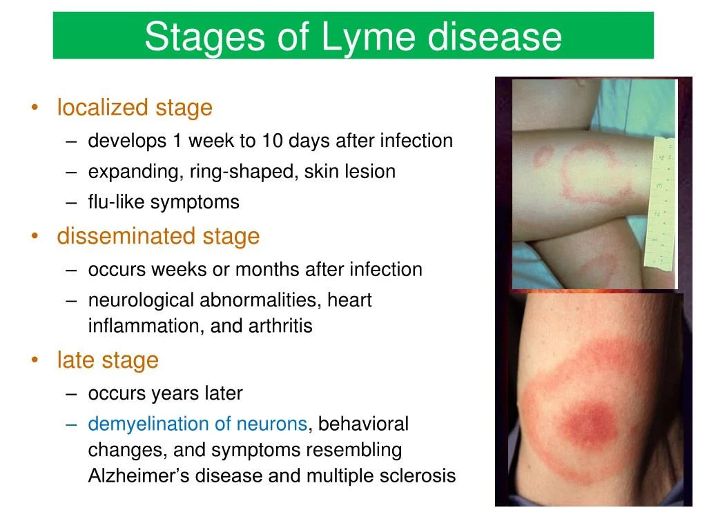 Early Disseminated Stage (Weeks to Months) – Middle Stages of Lyme Disease