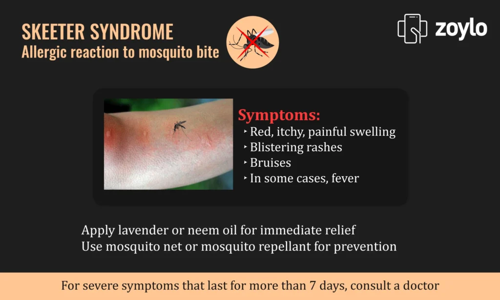 Recognizing the Signs of a Mosquito Bite Reaction