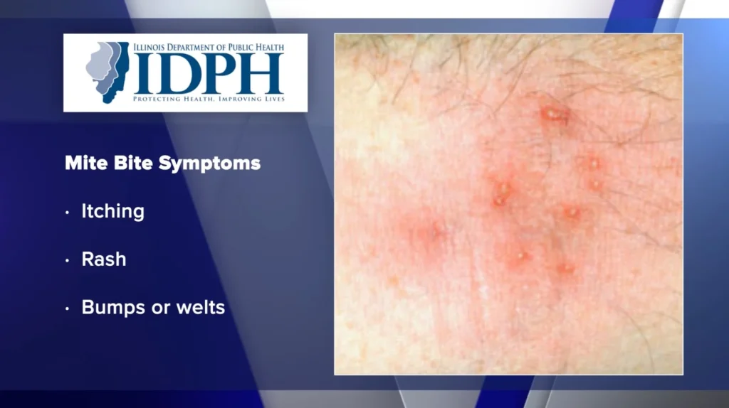 Recognizing the Signs of Mite Bites on Humans