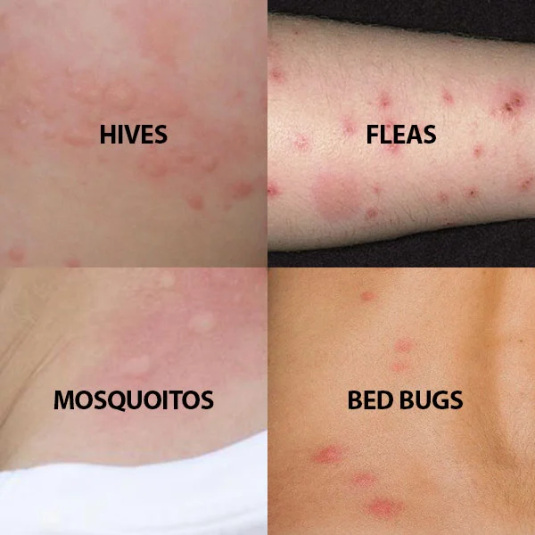 What Do Bed Bug Bites Look Like? Identifying the Signature Marks