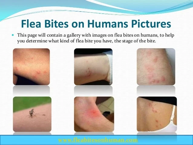 Why Flea Bites on Humans Occur