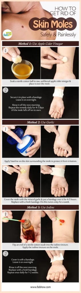 Identifying the Signs: How to Get Rid of Moles Effectively