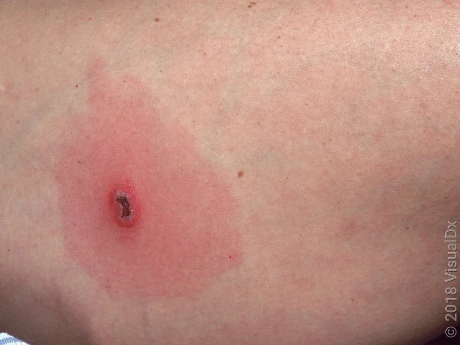 What Does a Parson Spider Bite Look Like? Typical Appearance and Timeline